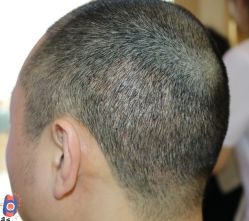 -大麦微针植发丨全国连锁