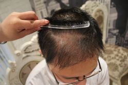 -大麦微针植发丨全国连锁