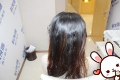 点击看大图 -大麦微针植发丨全国连锁