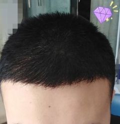 -大麦微针植发丨全国连锁