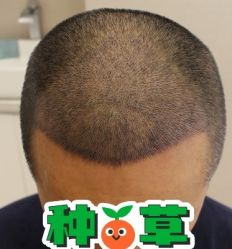 -大麦微针植发丨全国连锁