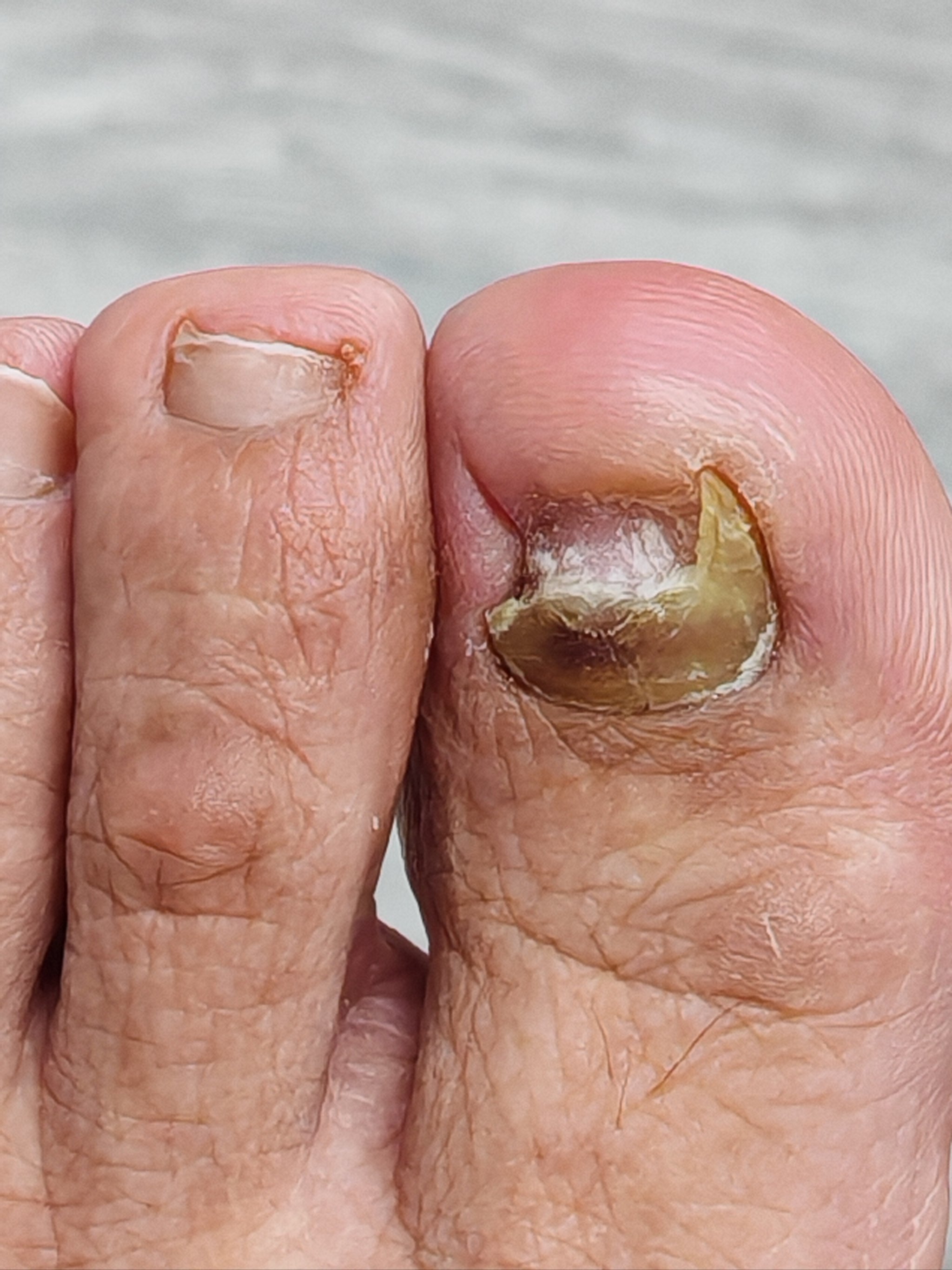 我的灰指甲有救了