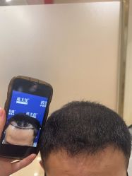 -碧莲盛·不剃发植发