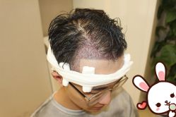 点击看大图 -大麦微针植发丨全国连锁