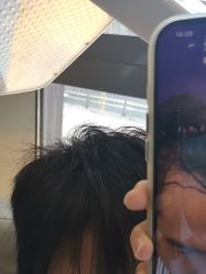 -碧莲盛·不剃发植发