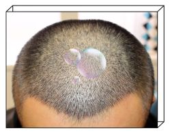 -大麦微针植发全国连锁