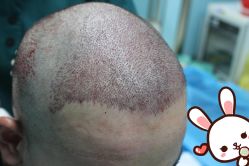 点击看大图 -大麦微针植发丨全国连锁