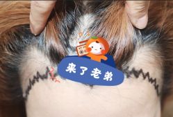 -大麦微针植发全国连锁