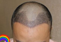 -大麦微针植发丨全国连锁