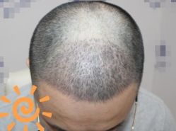 -大麦微针植发丨全国连锁