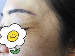 体验前-More摩尔医美の注射线雕光电中心