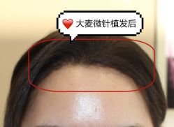 -大麦微针植发全国连锁