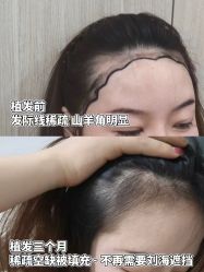 点击看大图 -雍禾植发