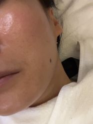 体验后-皇族养心堂·净痘·修敏·御颜