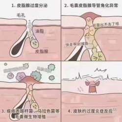 -靓芙泉祛痘.科技美肤连锁