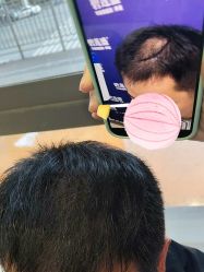 -碧莲盛·不剃发植发