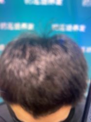 -碧莲盛·不剃发植发