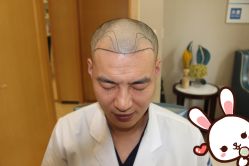 -大麦微针植发丨全国连锁