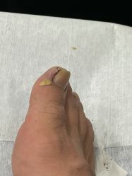 -德哥灰指甲脚气甲沟炎跖疣护理