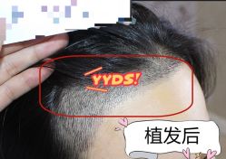 -大麦微针植发全国连锁