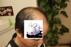 -大麦微针植发丨全国连锁