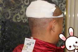 点击看大图 -大麦微针植发丨全国连锁