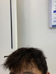 -大麦微针植发丨全国连锁