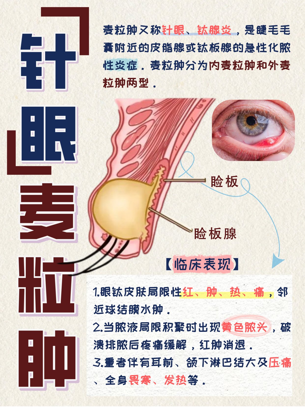 麦粒肿能挤吗图片