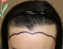 点击看大图 -大麦微针植发全国连锁