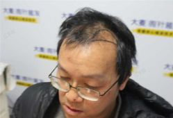 -大麦微针植发丨全国连锁
