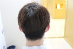 点击看大图 -大麦微针植发丨全国连锁