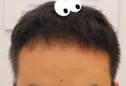 -大麦微针植发全国连锁