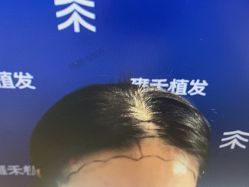 -雍禾植发全国连锁