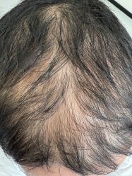 体验前-大麦微针植发全国连锁