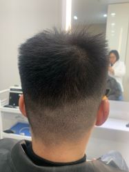 体验后-大麦微针植发全国连锁