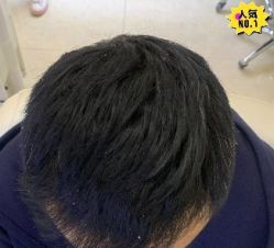 -大麦微针植发丨全国连锁