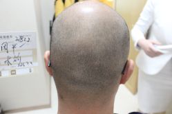 点击看大图 -大麦微针植发丨全国连锁