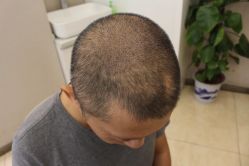 -大麦微针植发丨全国连锁