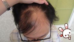 -大麦微针植发丨全国连锁