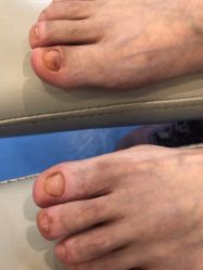 -足太医扦脚·灰指甲·嵌甲