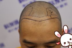 点击看大图 -大麦微针植发丨全国连锁