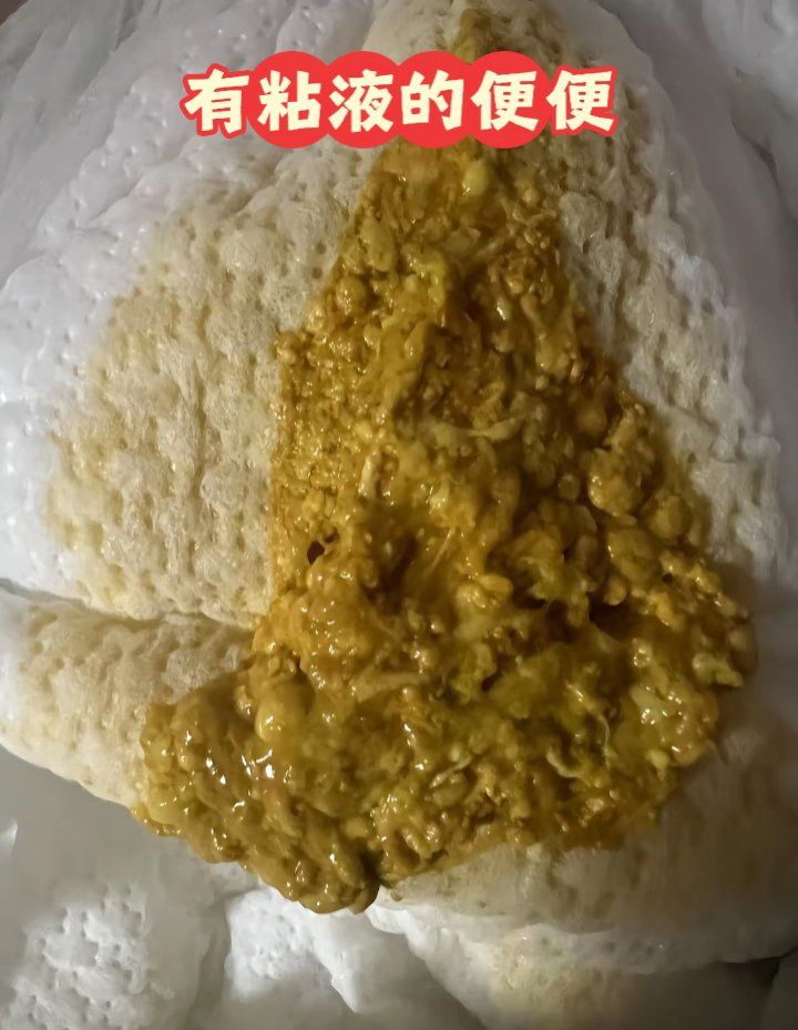 大便多为黄色稀便或蛋花汤样便,还可能伴有泡沫和酸臭味