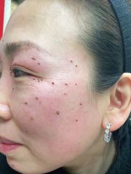 -北京美痣堂古方祛痣斑疣瘊