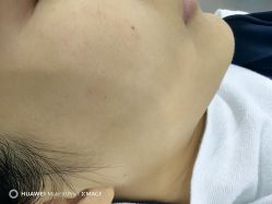 -蕾特恩专业祛痘国际连锁