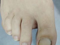 -祖传修脚甲沟炎灰指甲鸡眼