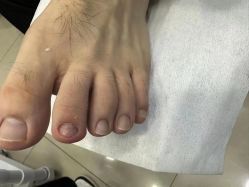 -德哥灰指甲脚气甲沟炎跖疣护理