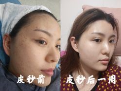 体验前-More摩尔医美の注射线雕光电中心