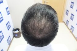 -大麦微针植发丨全国连锁