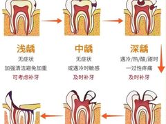 -上海仁爱医院口腔科 · 种植