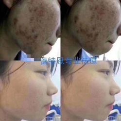 点击看大图 -蕾特恩专业祛痘·皮肤管理